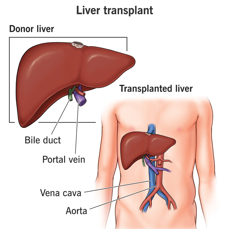 liver-transplant dr ravi chandra reddy